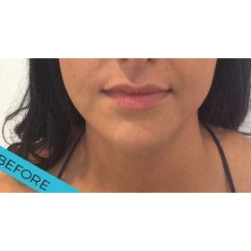 JB Cosmetic: Explore lip fillers Cardiff
