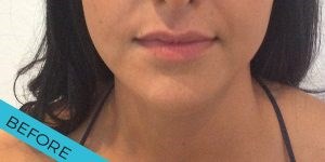 JB Cosmetic: Explore lip fillers Cardiff